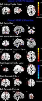 Intermittent Theta-Burst Stimulation Over the Suprahyoid Muscles Motor Cortex Facilitates Increased Degree Centrality in Healthy Subjects